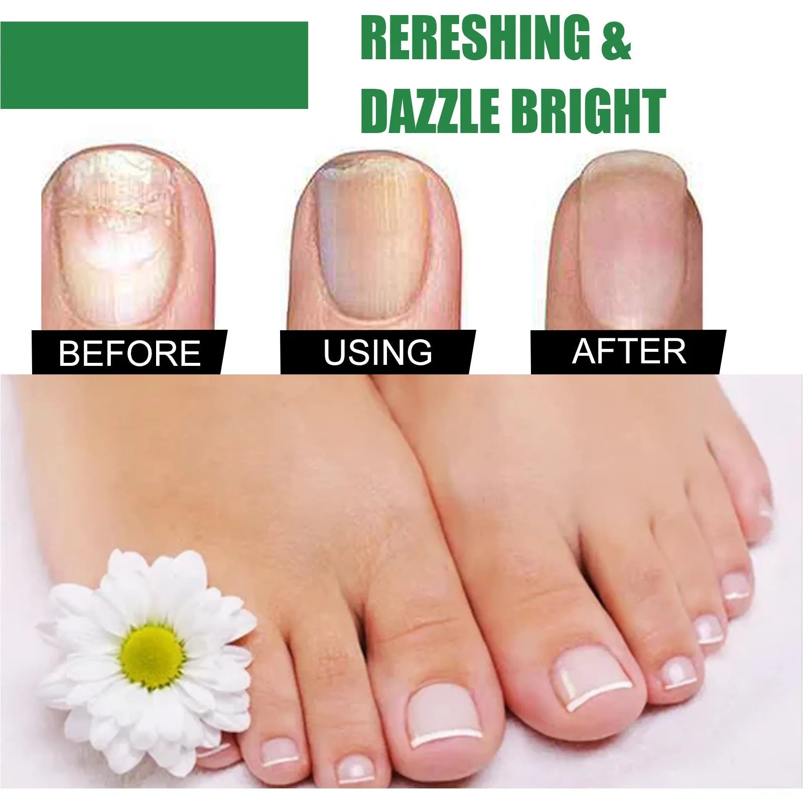 30ml bottle of thick tea tree oil nail care solution for hands and feet