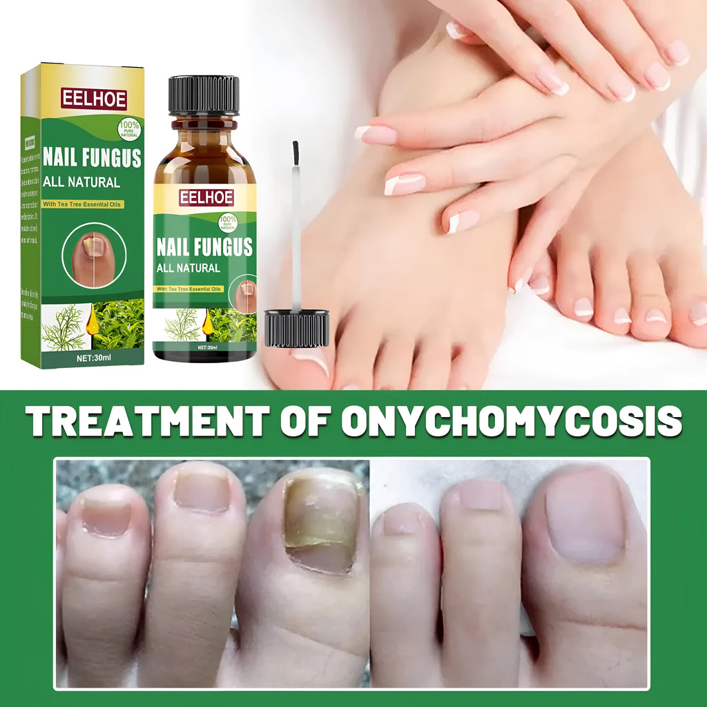 30ml bottle of thick tea tree oil nail care solution for hands and feet