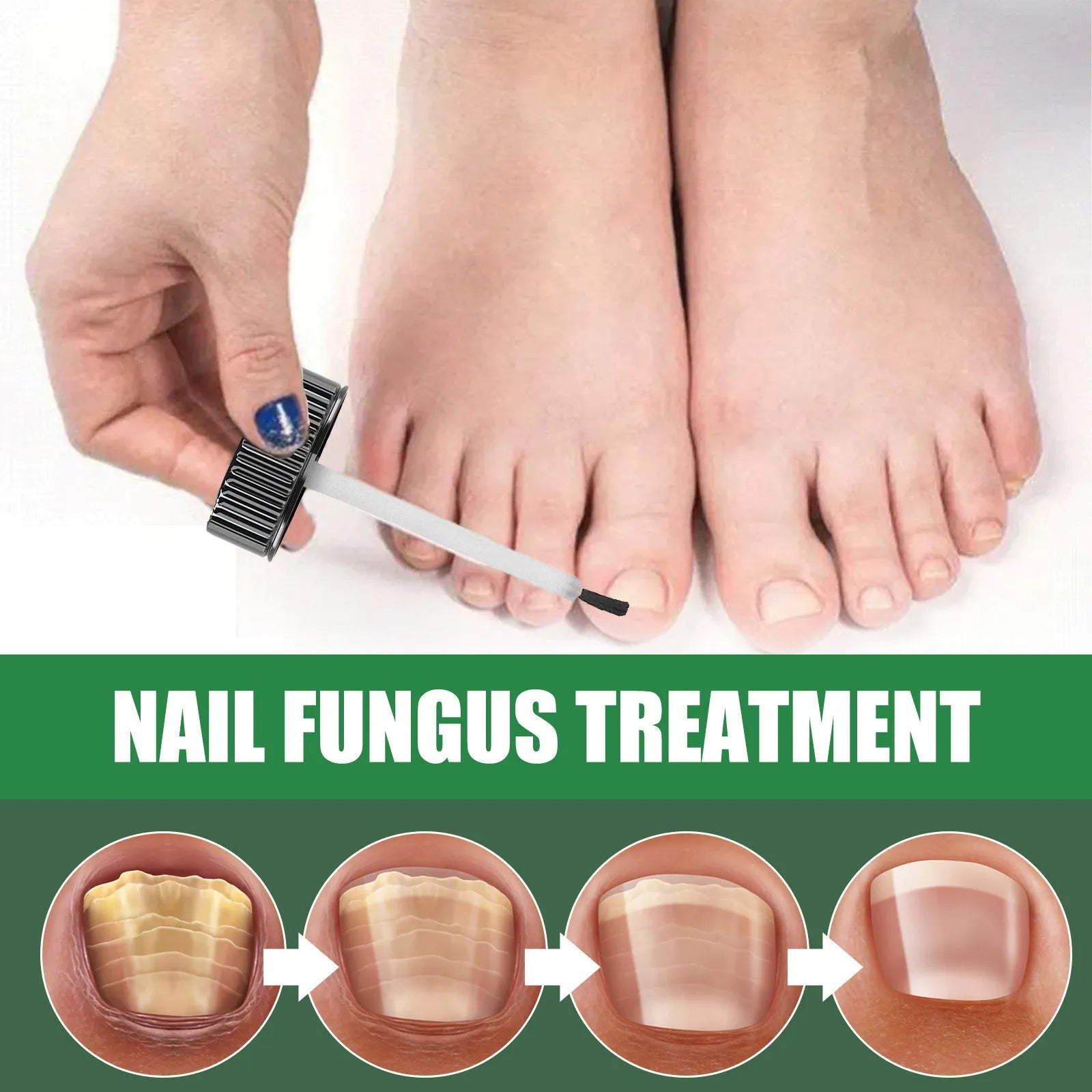 30ml bottle of thick tea tree oil nail care solution for hands and feet